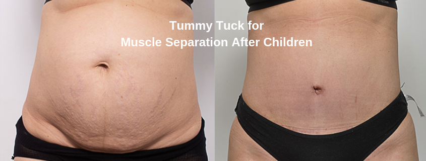 Tummy Tuck for Muscle Separation After Children