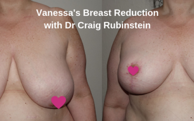 Vanessa’s Breast Reduction Patient Story with Dr Craig Rubinstein
