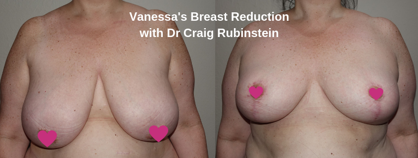 Vanessa’s Breast Reduction Patient Story with Dr Craig Rubinstein