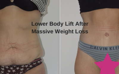 Lower Body Lift After Massive Weight Loss – See Patient Results by Dr Jeremy Hunt