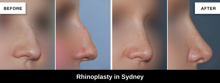 Different Types of Popular Noses and Rhinoplasty in Sydney with A/Prof Mark Gianoutsos