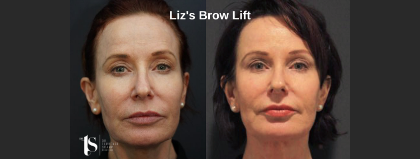 Liz’s Brow Lift with Dr Terrence Scamp, Specialist Plastic Surgeon