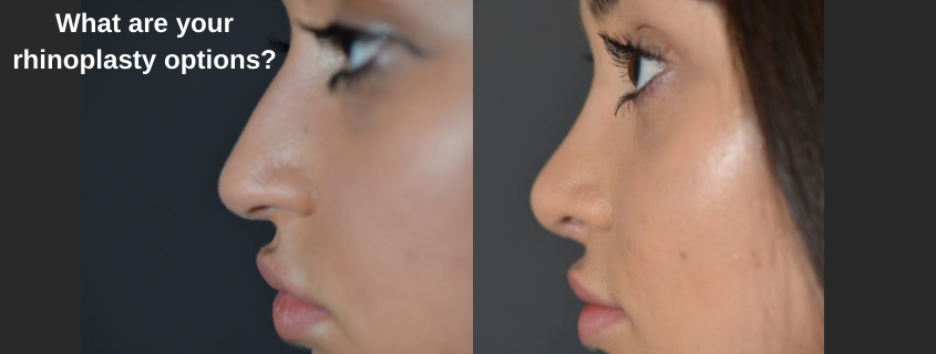 What Are Your Rhinoplasty Options for the BEST Sydney Nose Job with Dr Jack Zoumaras?