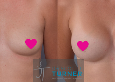 Renowned Breast Enhancement Specialist