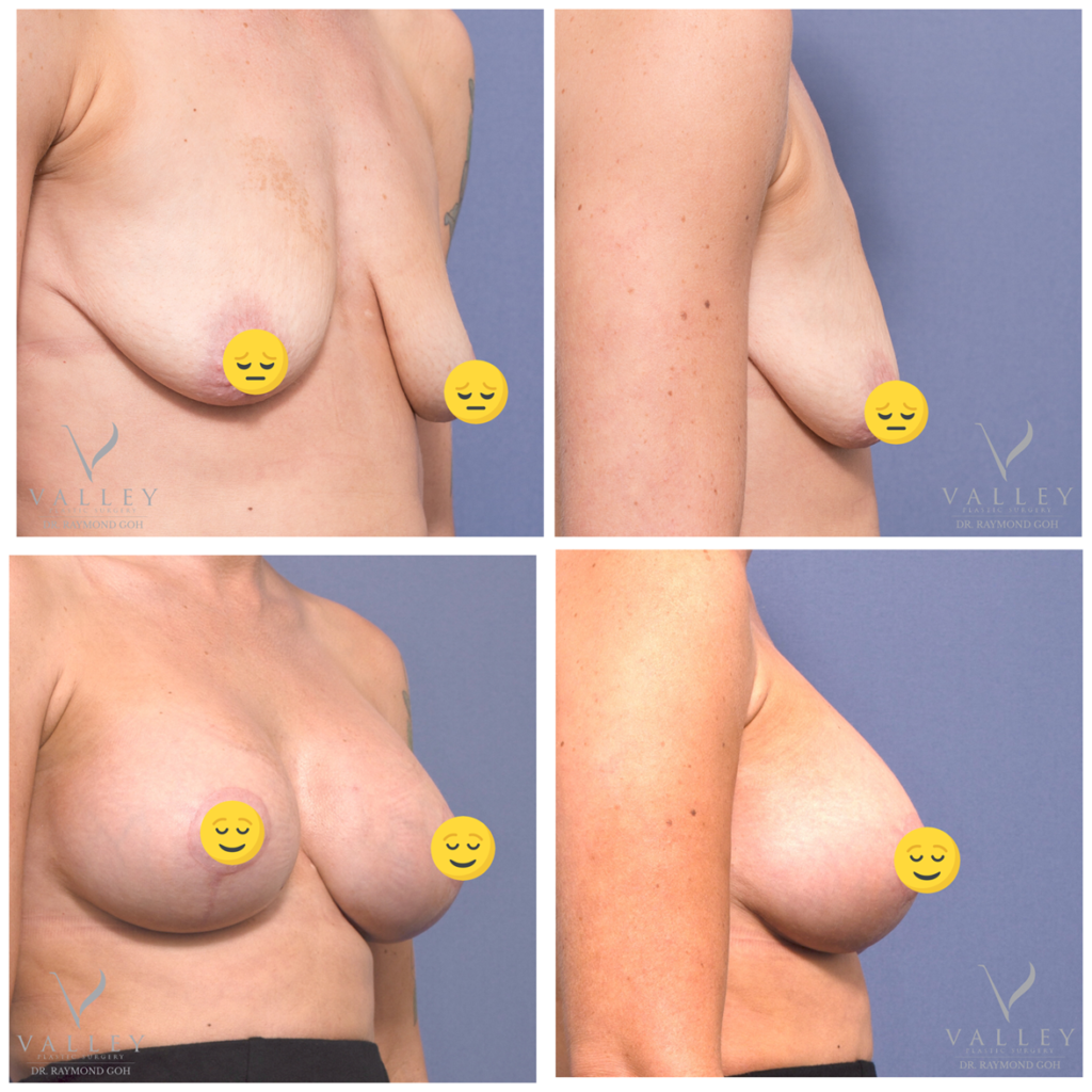 Breast Implant or Breast Lift