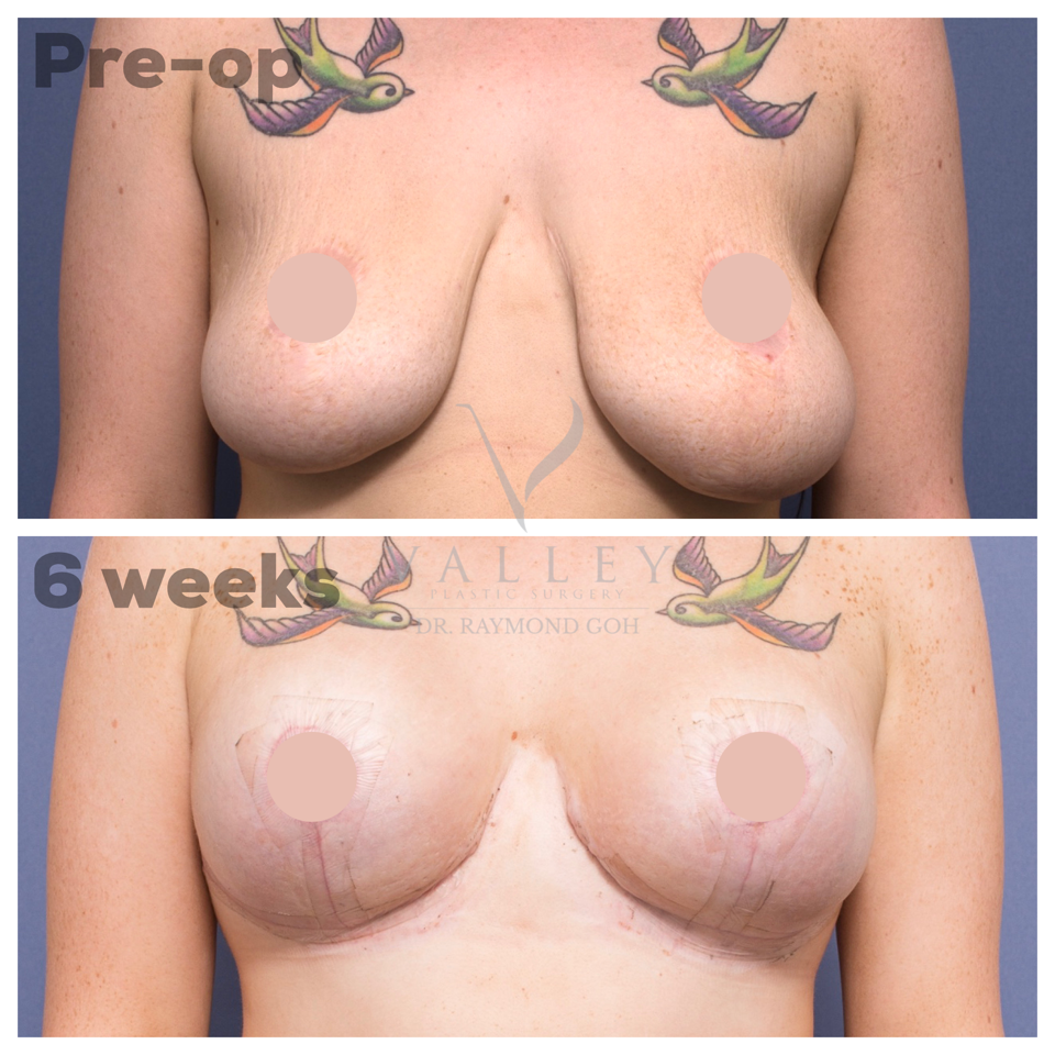 Breast implants or breast lift
