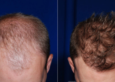 Neograft Hair Restoration