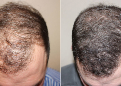 Neograft Hair Restoration
