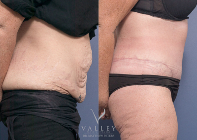 6 weeks post belt lipectomy - Minimising Surgical Scars
