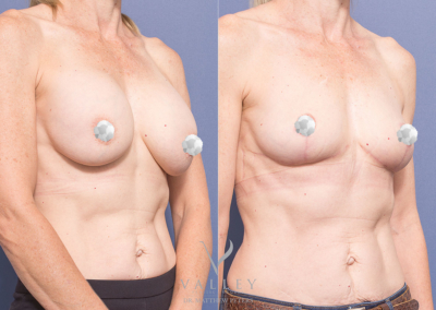 12 weeks post removal and replacement of bilateral implants and bilateral mastopexies - Minimising Surgical Scars