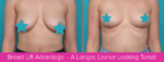breast lift blog header
