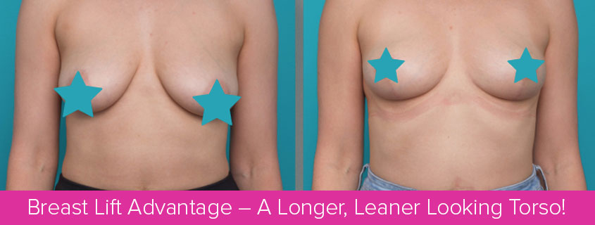 Breast Lift Advantage – A Longer, Leaner Looking Torso!