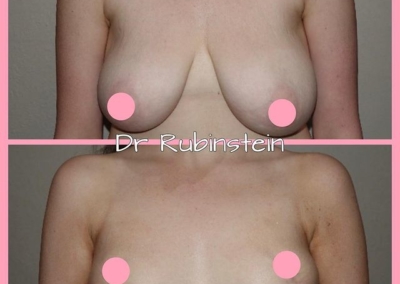 7 Top Tips for a Great Recovery After Breast Augmentation