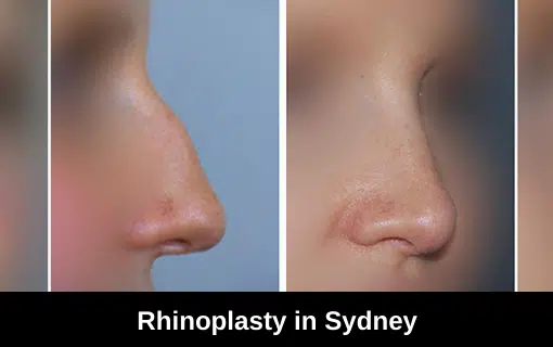 Types of Rhinoplasty in Sydney with Dr Mark Gianoutsos
