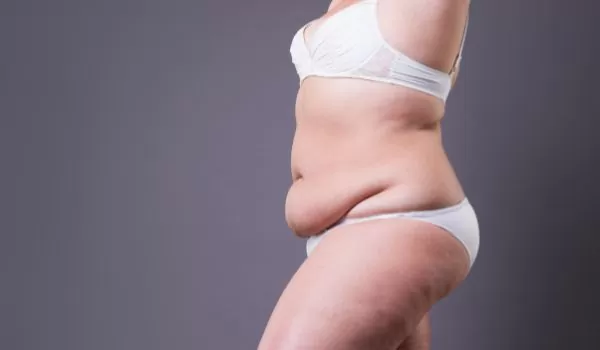 Does Medicare Cover My Tummy Tuck - Woman in White bra and Panty