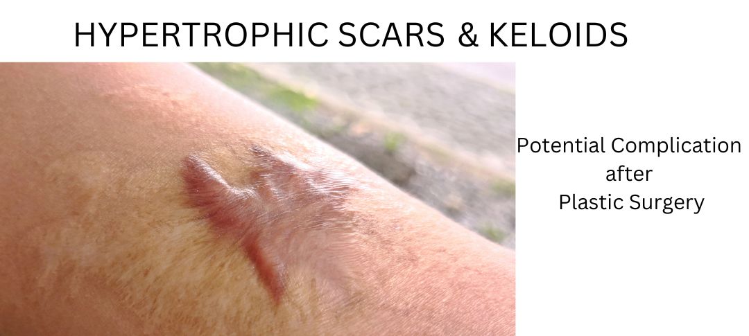 Hypertrophic Scars and Keloids – Possible Complication after Plastic Surgery