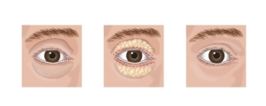 Blepharoplasty (Eyelid Lift Surgery) – The Ultimate Solution for Tired-Looking Eyes